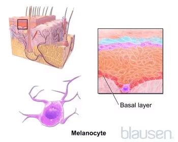 melasma2