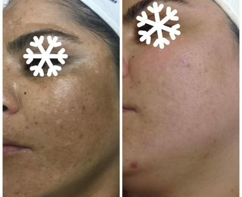 melasma6
