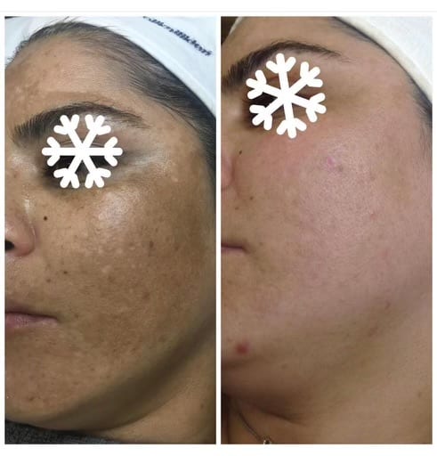 melasma6