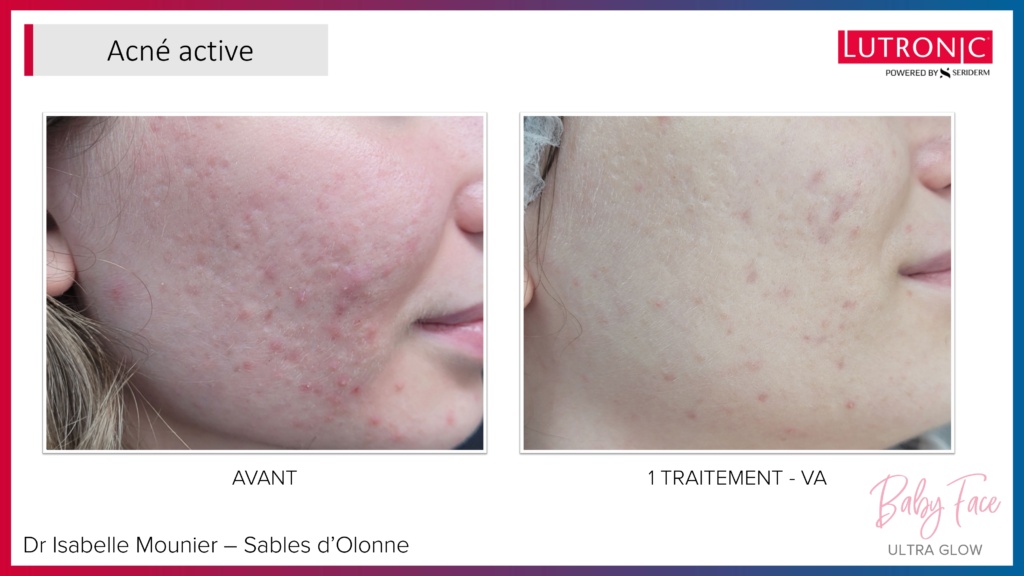 Cas Cliniques GENIUS + LASEMD & ULTRA_page-0005 Cas Cliniques GENIUS + LASEMD & ULTRA_page-0005