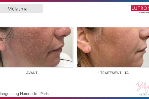 Cas Cliniques GENIUS + LASEMD & ULTRA_page-0006