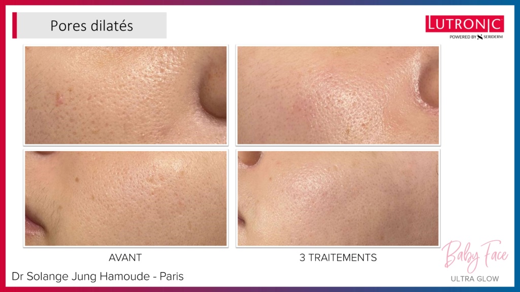 Cas Cliniques GENIUS + LASEMD & ULTRA_page-0007 Cas Cliniques GENIUS + LASEMD & ULTRA_page-0007