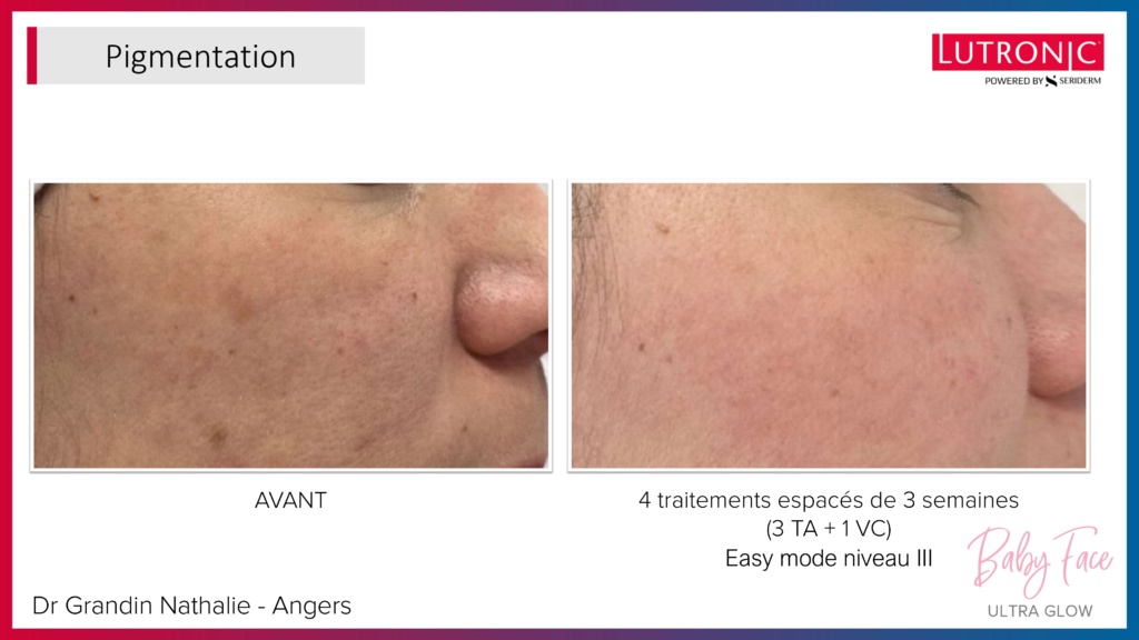 Cas Cliniques GENIUS + LASEMD & ULTRA_page-0008 Cas Cliniques GENIUS + LASEMD & ULTRA_page-0008