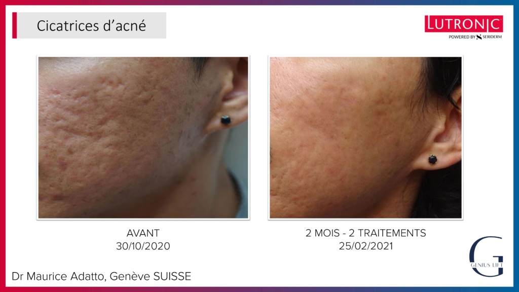 Cas Cliniques GENIUS + LASEMD & ULTRA_page-0015 Cas Cliniques GENIUS + LASEMD & ULTRA_page-0015