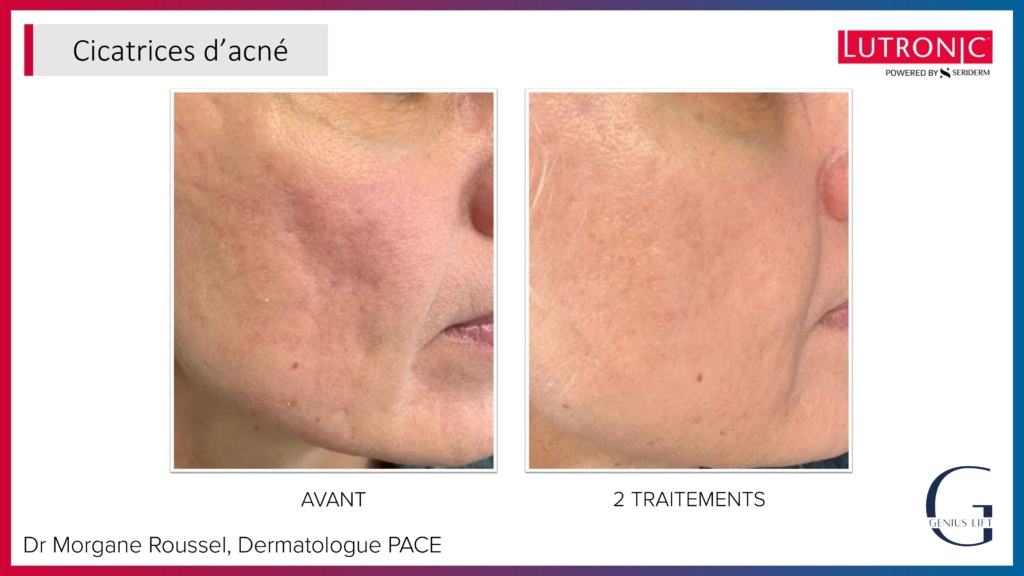 Cas Cliniques GENIUS + LASEMD & ULTRA_page-0017 Cas Cliniques GENIUS + LASEMD & ULTRA_page-0017