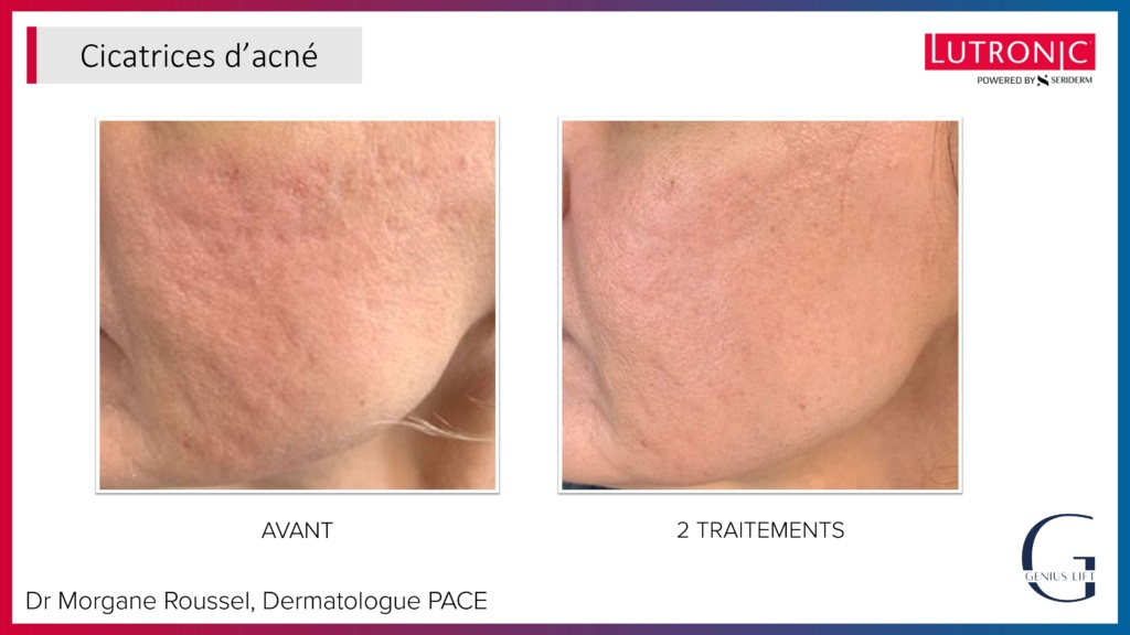 Cas Cliniques GENIUS + LASEMD & ULTRA_page-0018 Cas Cliniques GENIUS + LASEMD & ULTRA_page-0018