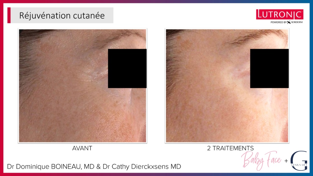 Cas Cliniques GENIUS + LASEMD & ULTRA_page-0029