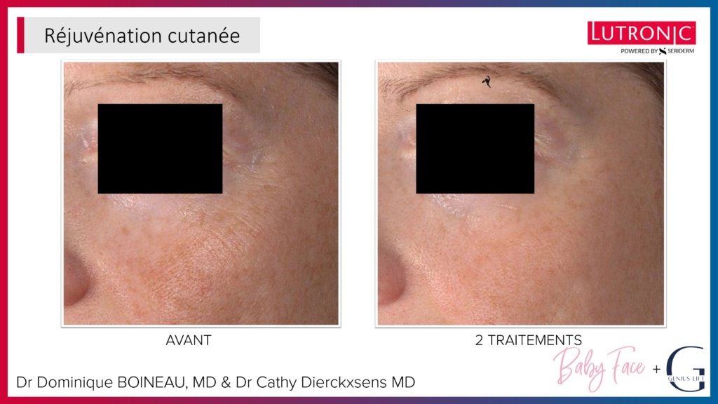 Cas Cliniques GENIUS + LASEMD & ULTRA_page-0030