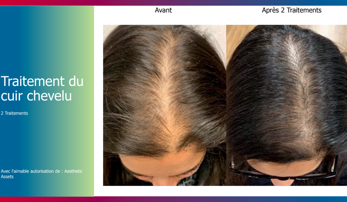 KERAFACTOR présentation clinique -17