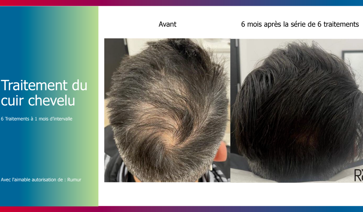 KERAFACTOR présentation clinique -19