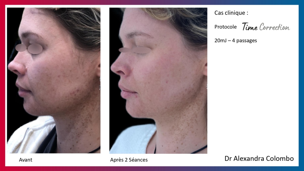 Présentation LaseMD Ultra_page-0023