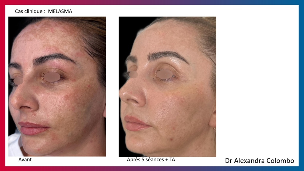 Présentation LaseMD Ultra_page-0033 Présentation LaseMD Ultra_page-0033